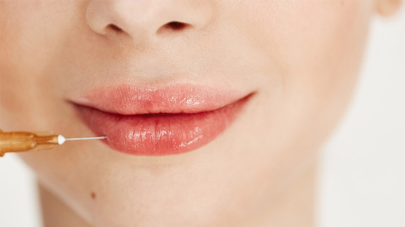 تزریق فیلر لب