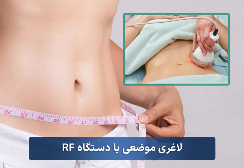 لاغری-موضعی-با-دستگاه-RF