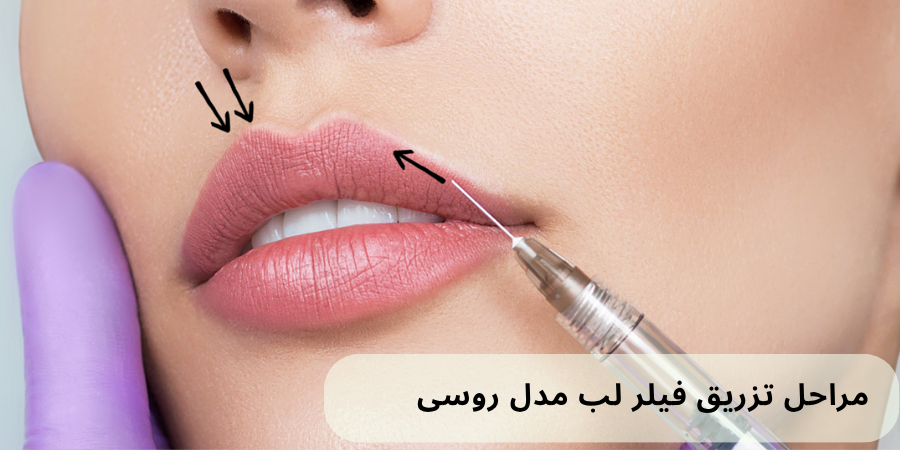 مراحل تزریق فیلر لب روسی