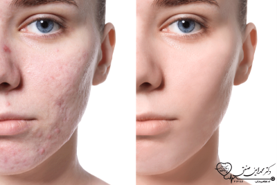 مزوتراپی تخصصی برای جای جوش، اسکار و تقویت پوست