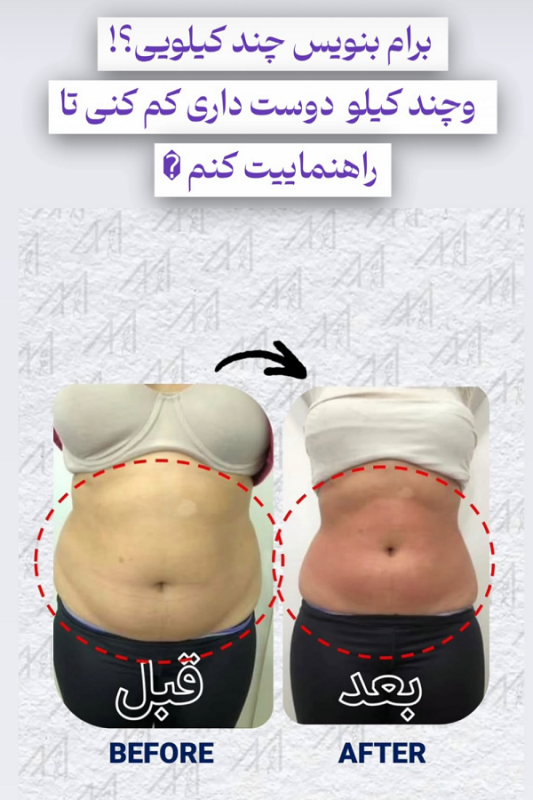 عکس لاغری با دستگاه ساری