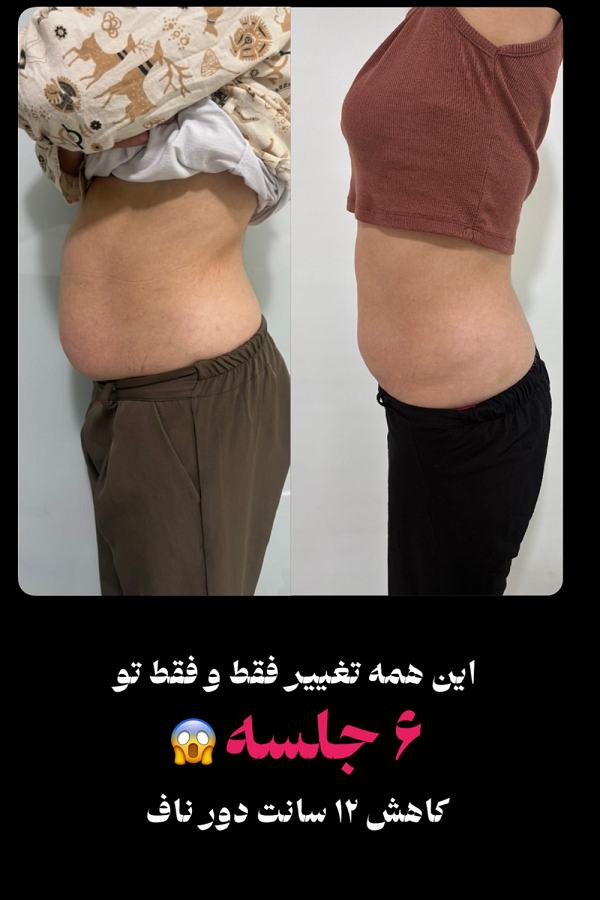 عکس لاغری موضعی در ساری