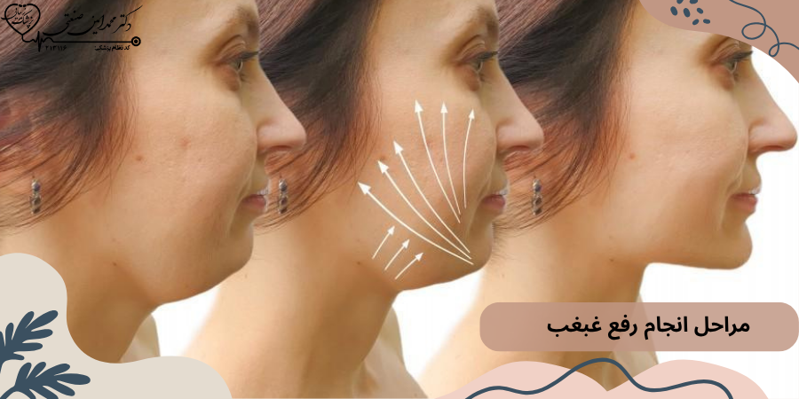 مراحل انجام رفع غبغب