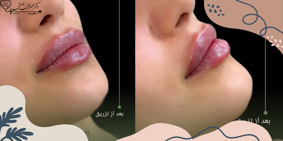 تزریق فیلر لب روسی در ساری