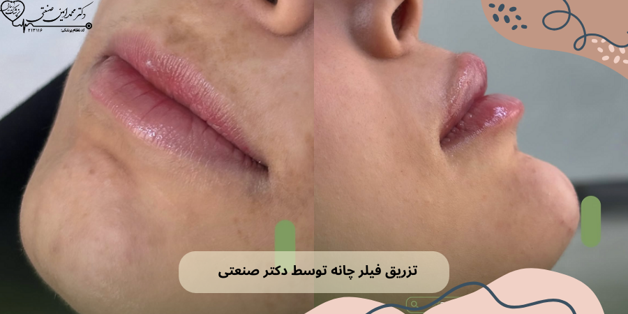 تزریق فیلر چانه در ساری