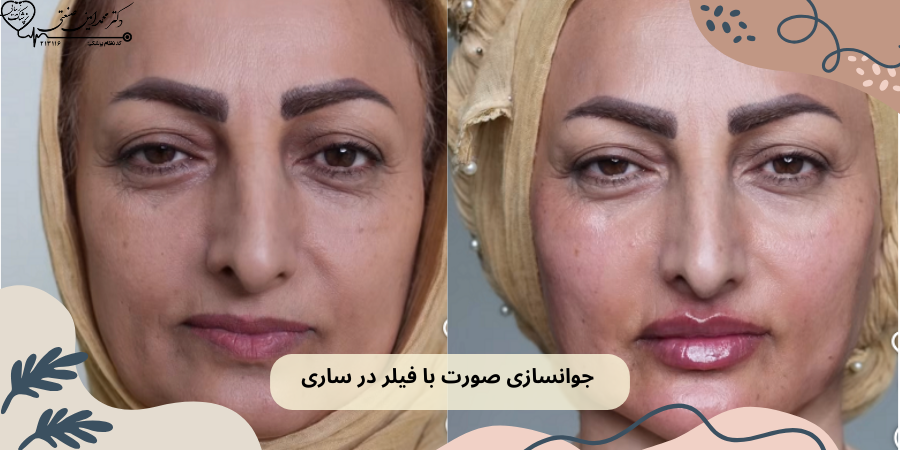 جوانسازی صورت با فیلر در ساری