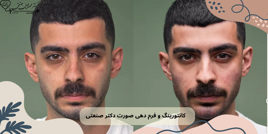 کانتورینگ صورت توسط بهترین دکتر فیلر ساری
