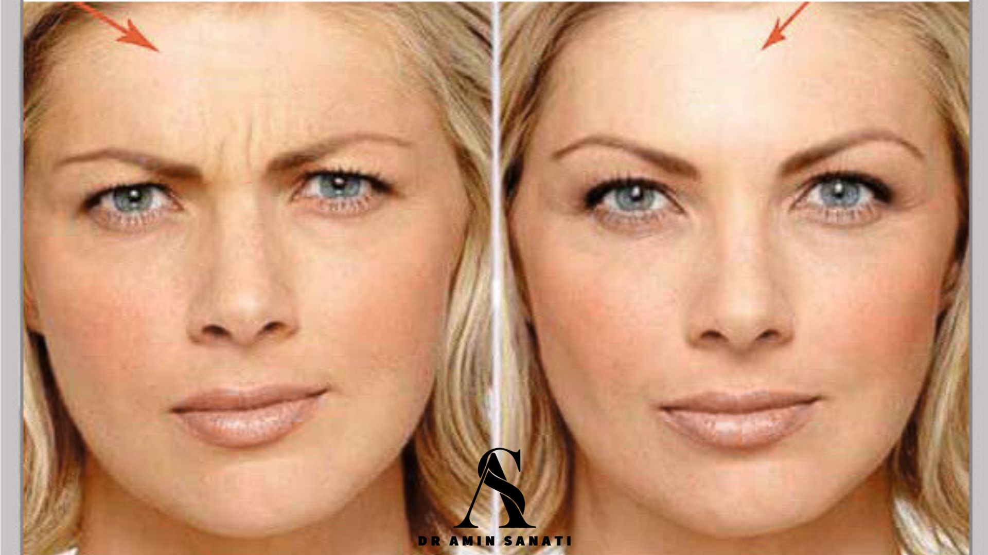 مراقبت‌های قبل از تزریق بوتاکس