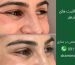 مراقبت های بعداز تزریق