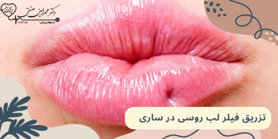 تزریق فیلر لب روسی در ساری