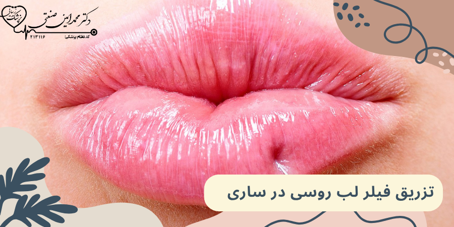 تزریق فیلر لب روسی در ساری