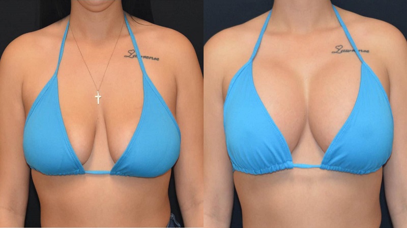 فیلر بادی سینه