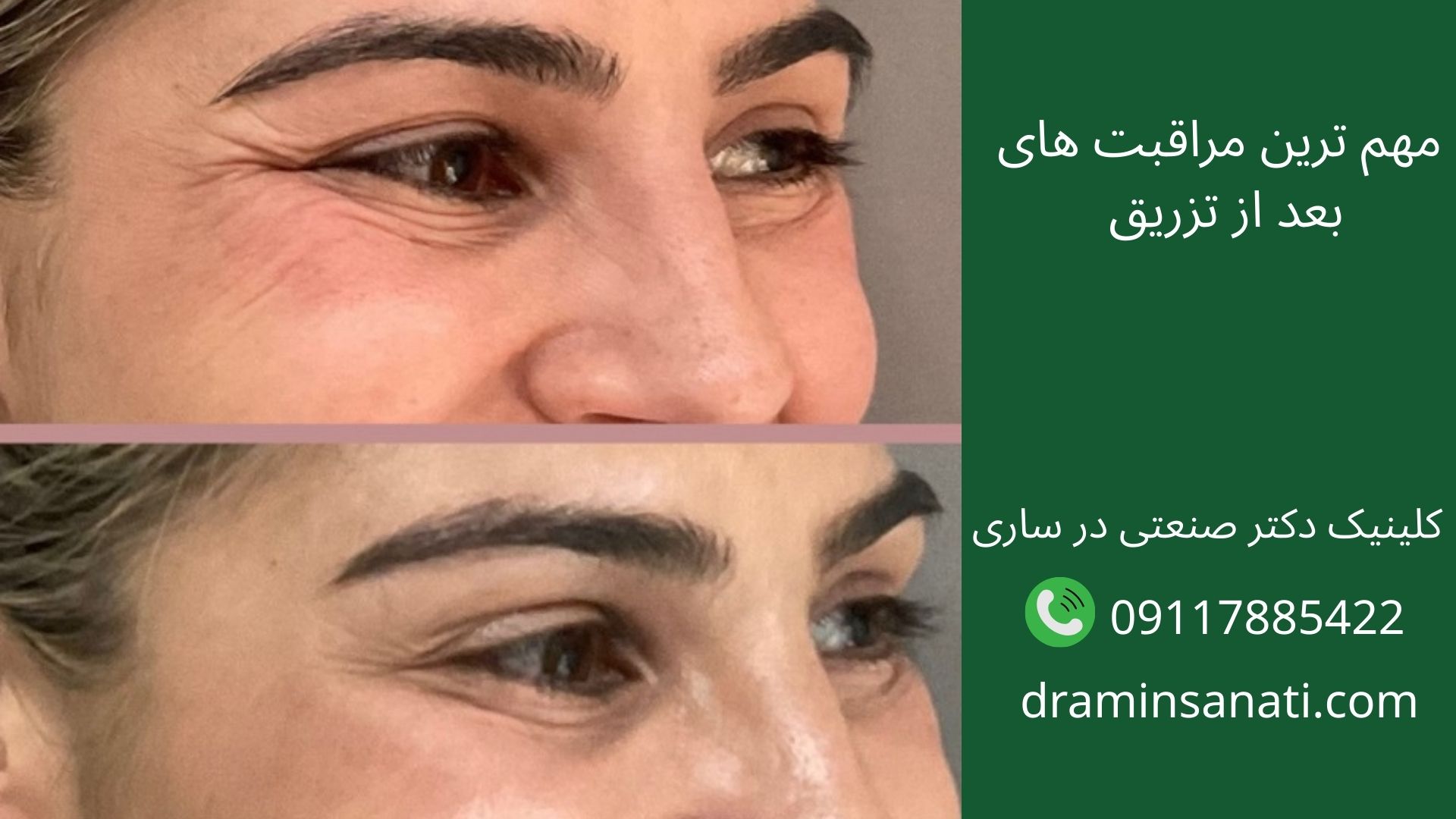 مراقبت های بعداز تزریق